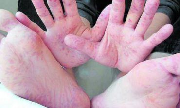 Piura: Aumentan a 74 los casos del síndrome de pies, manos y boca
