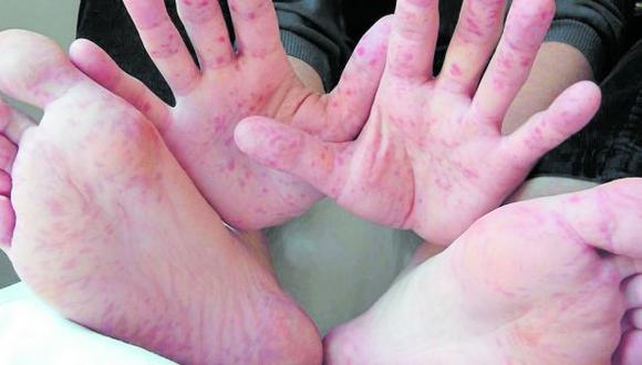 Piura: Aumentan a 74 los casos del síndrome de pies, manos y boca