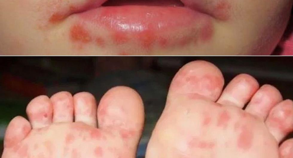 Diresa confirma 25 casos del virus coxsackie en Piura, Sullana y Talara