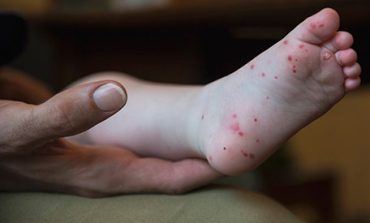 Piura: Colegio Médico recomienda reforzar higiene para evitar virus de manos, pies y boca