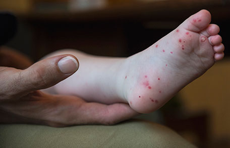 Piura: Colegio Médico recomienda reforzar higiene para evitar virus de manos, pies y boca