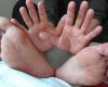 ¿En qué consiste y cómo podemos evitar la enfermedad de manos, pies y boca?