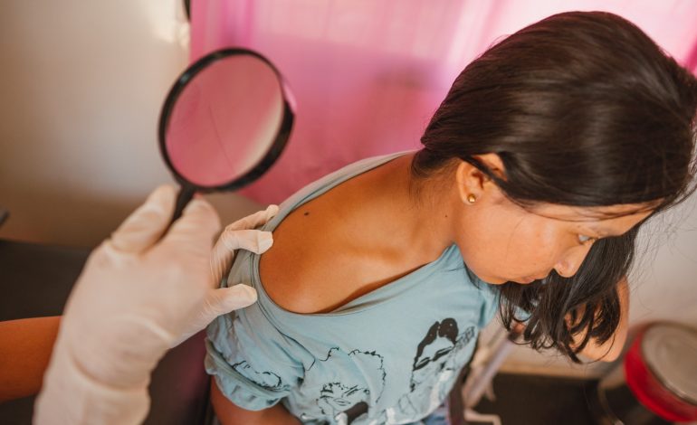 La Liga Contra el Cáncer inicia campaña gratuita contra el cáncer de piel en Piura