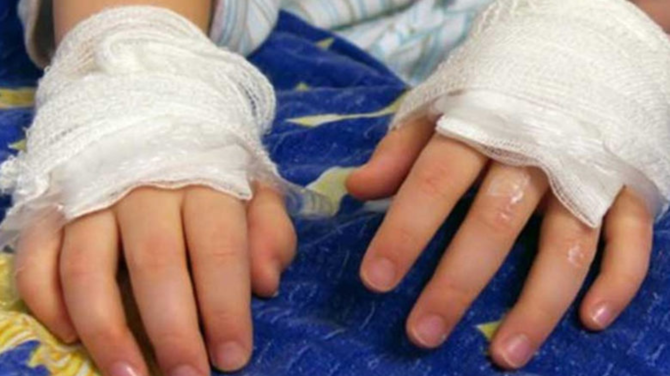 Huancayo: Madre castiga a su hija de cuatro años quemándole las manos