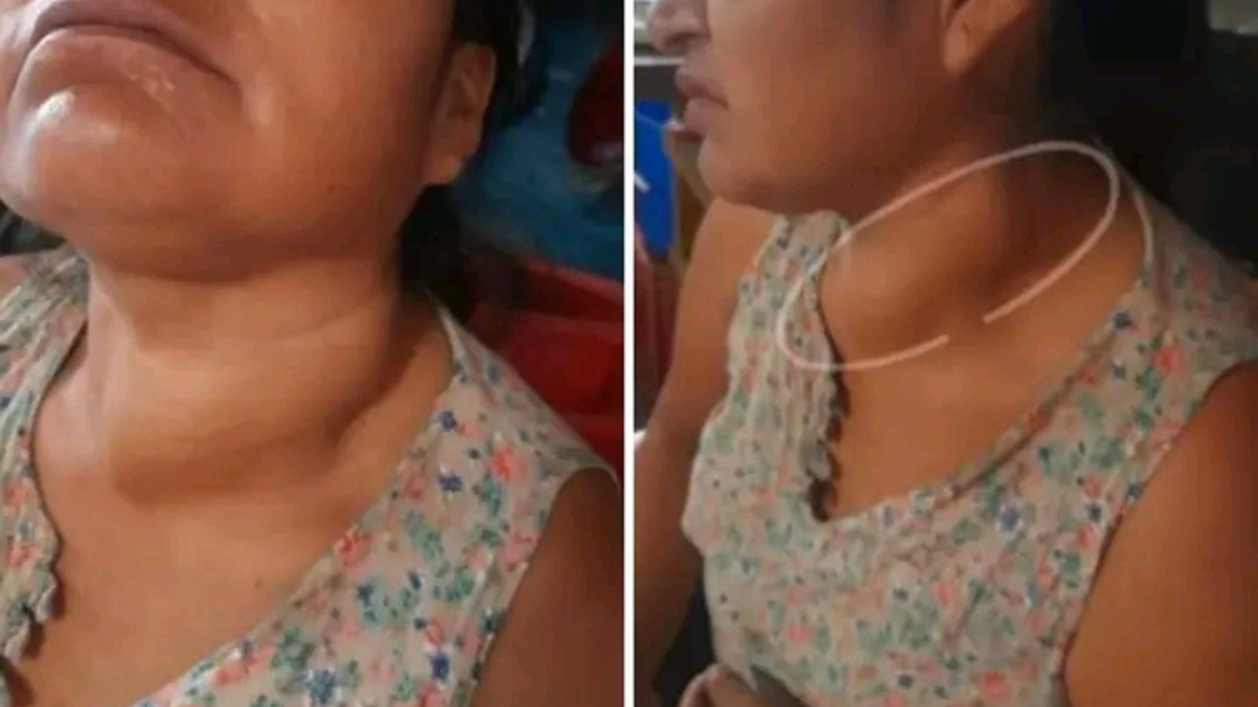 Urgente: Huancabambina con tumores necesita operación para salvar su vida