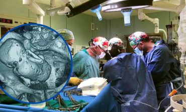 Brasil: Médicos descubren un ‘bebé de piedra’ en el vientre de una mujer de 81 años