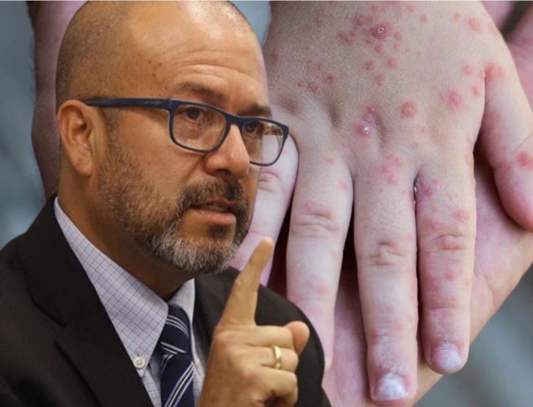 Exministro de Salud: debe declararse emergencia sanitaria contra el sarampión