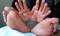 Piura: Síndrome de boca, manos y pies afecta a 6 niños de un mismo colegio inicial