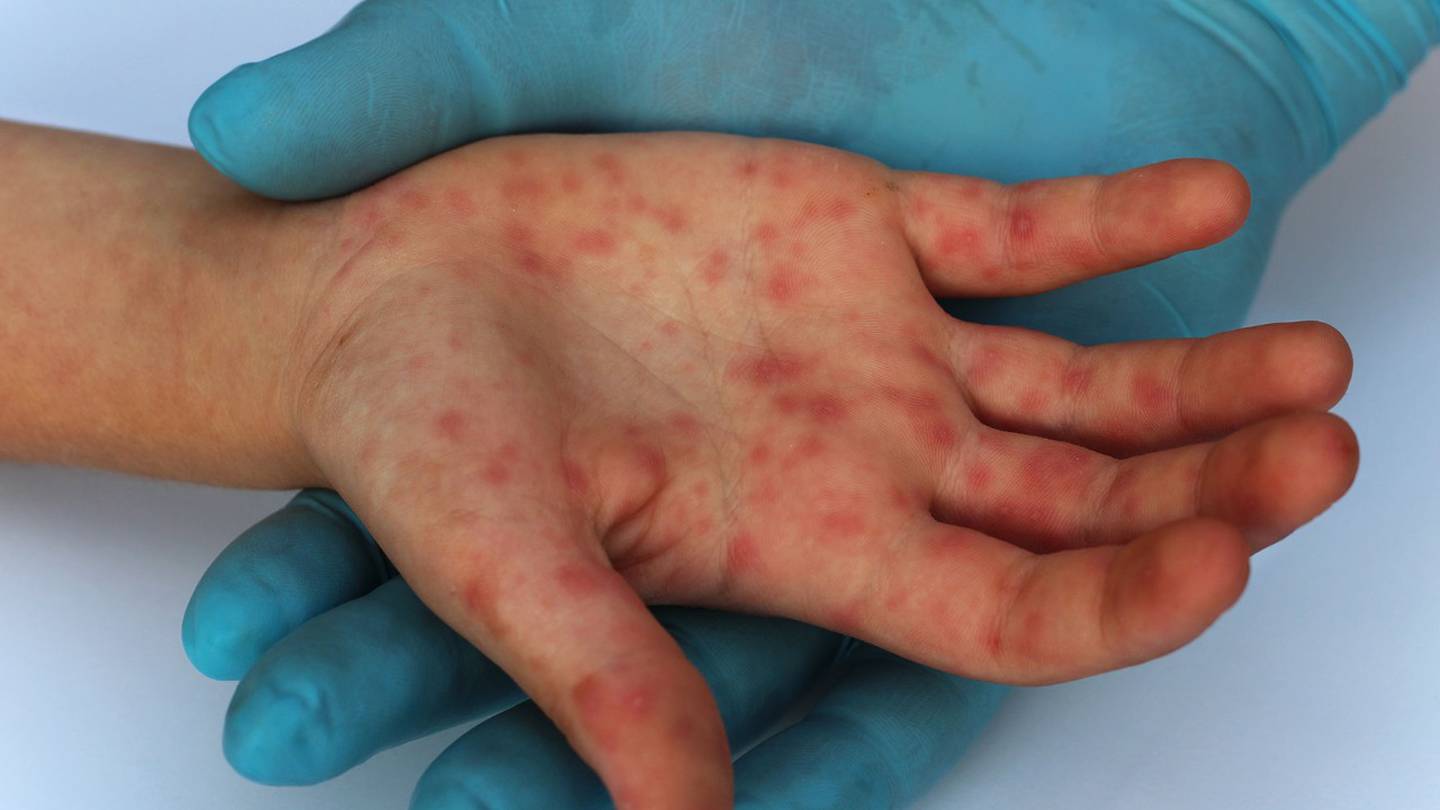 Piura: Viruela del mono puede causar ceguera indica especialista médico
