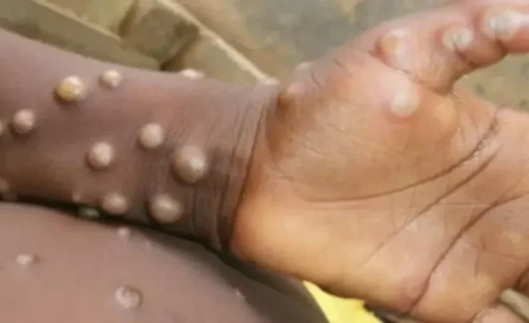 Mpox o ‘viruela del mono’: cómo se transmite, cuáles son los síntomas y todo lo que debes saber