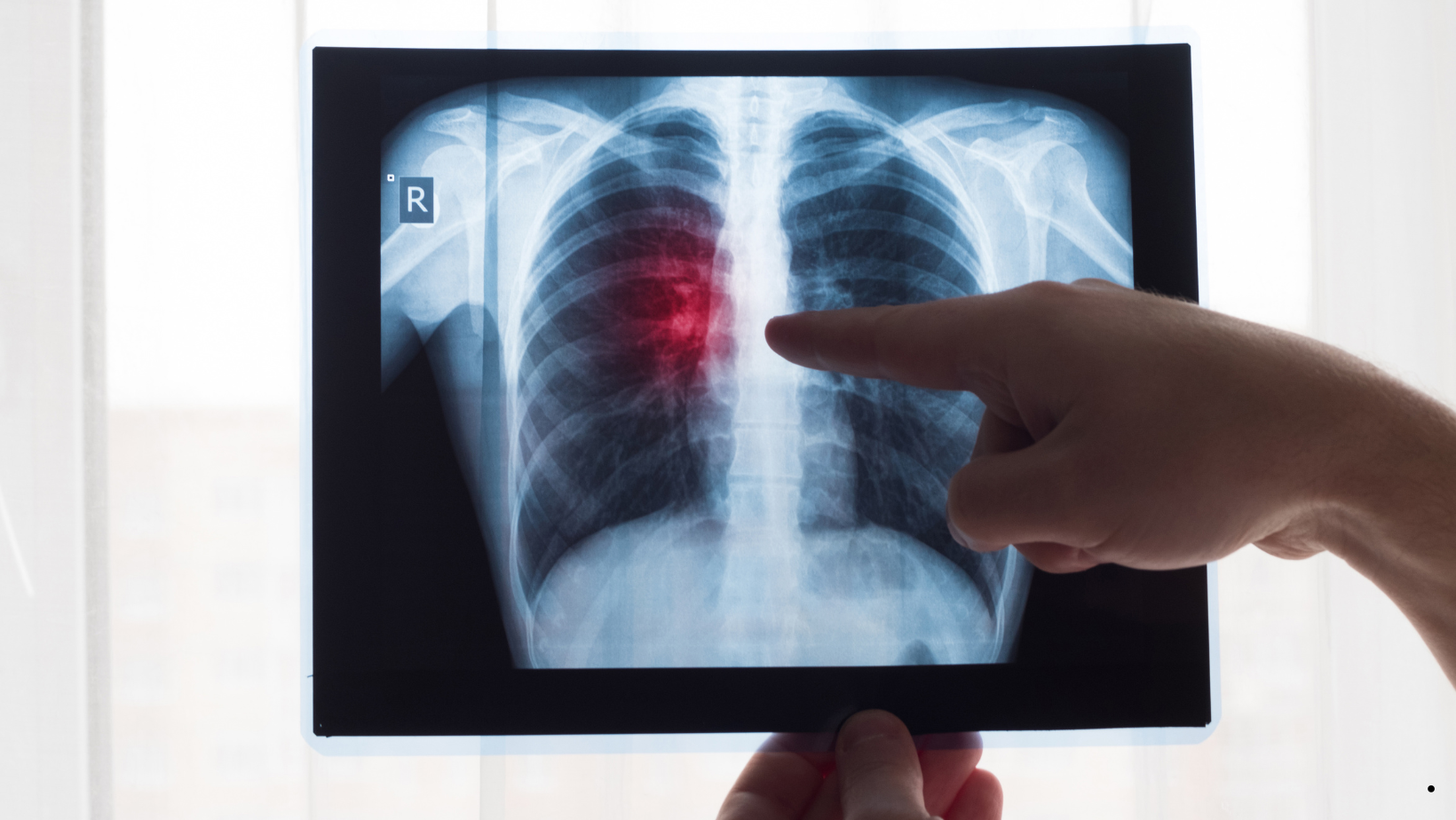 Cáncer de Pulmón: esta neoplasia representa el 5% de todas las causas de cáncer en Perú