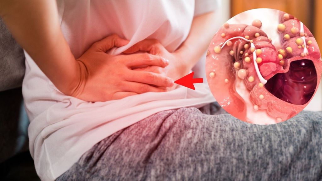 Día de la prevención de cáncer de colon: más de 400 casos se detectaron a nivel nacional