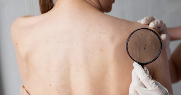 Protege tu piel este verano: Consejos esenciales para prevenir el cáncer de piel