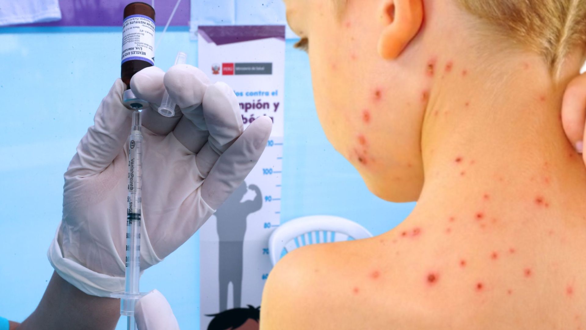 Minsa emite alerta sanitaria por posible ingreso de sarampión al Perú