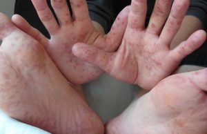 Piura: Confirman 10 casos de virus coxsackie en colegios de la región