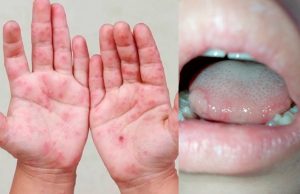 Piura: Especialista pide calma ante casos de mano, pie y boca en niños