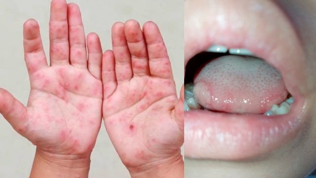 virus-coxsakie-carolina-nino-facebook