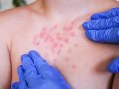 Minsa activa alerta epidemiológica nacional por expansión del sarampión