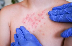 Minsa activa alerta epidemiológica nacional por expansión del sarampión